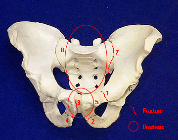 Pelvis model showing the 1983 injury context